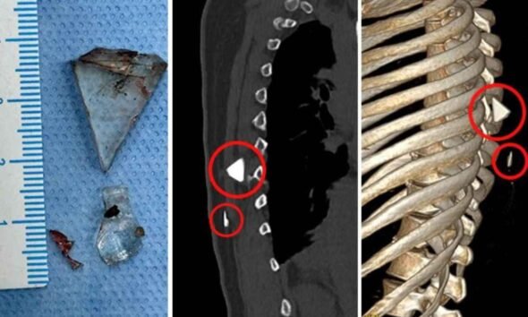 Kochi Doctors Find Glass Fragments Lodged in Woman's Spine