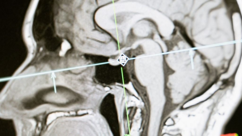 Brain cells: Sagittal MRI scan showing the human brain, brain stem and cerebellum with imaging crosshairs marking the brain-stem region.