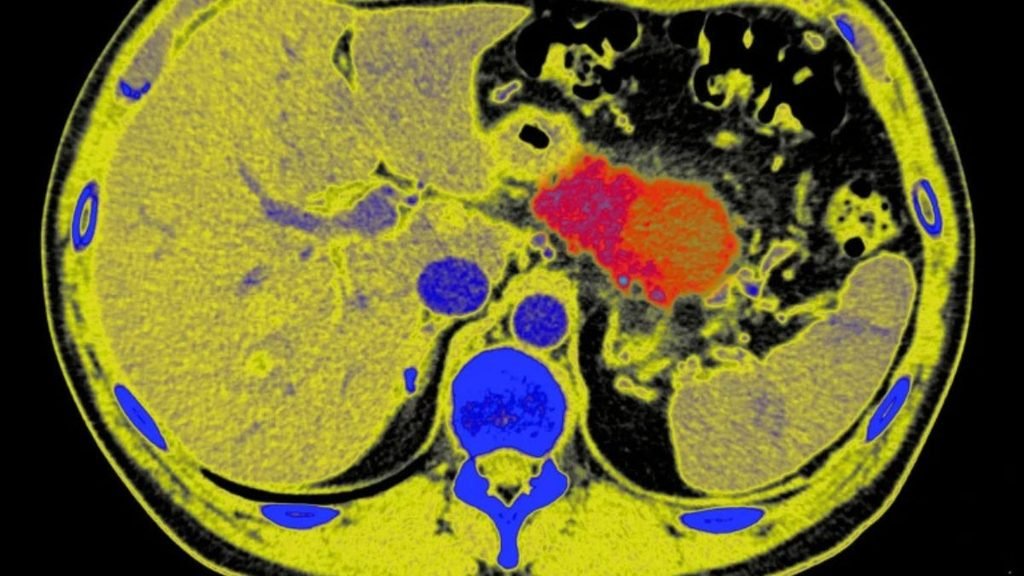 Pancreatic cancer